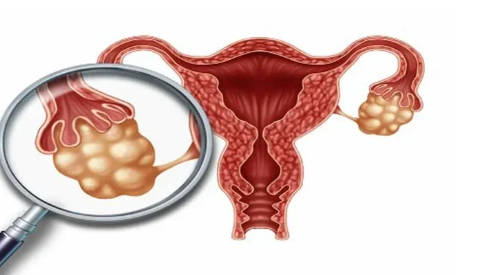 علاج تكيس المبايض وتأخر الحمل في عمان