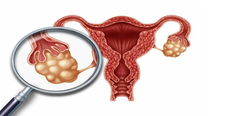 علاج تكيس المبايض وتأخر الحمل في عمان